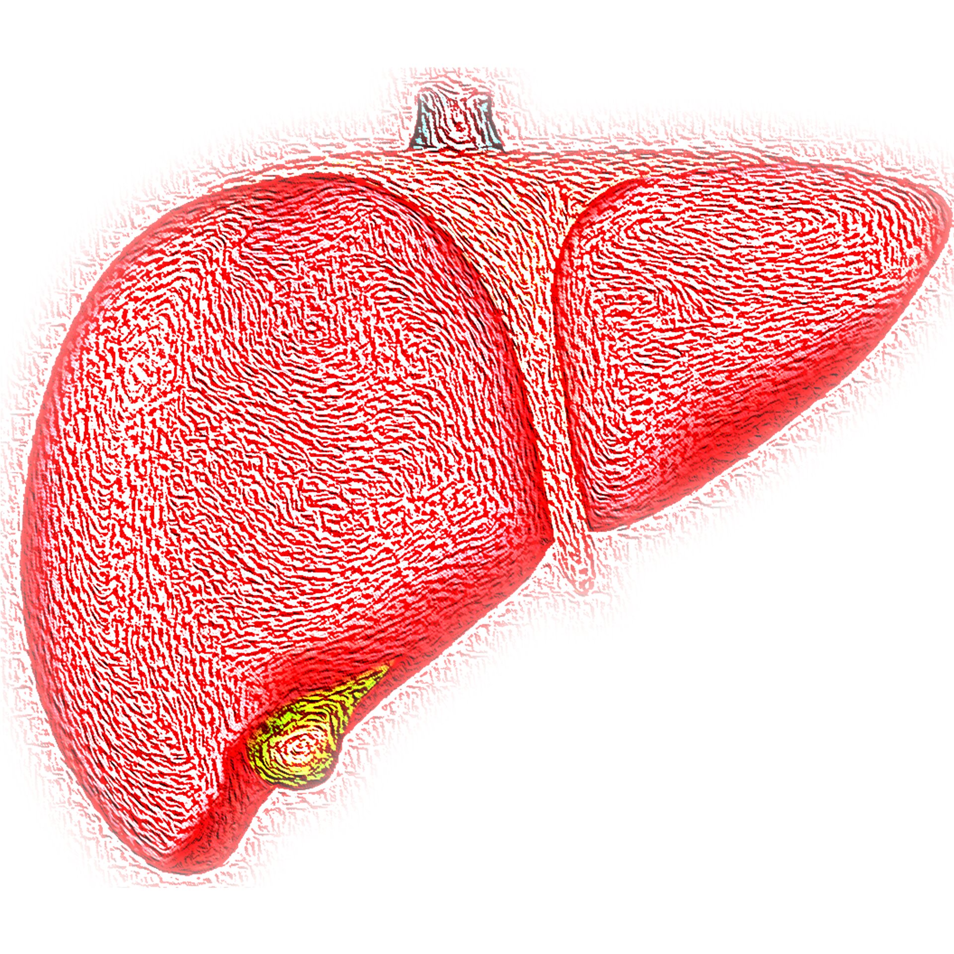 US approves first drug for severe form of fatty liver disease