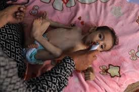 UN warns of surge in acute malnutrition among Gaza’s young children