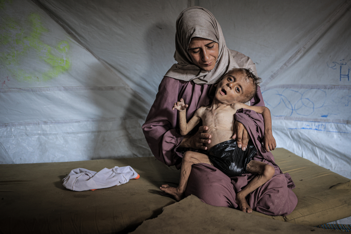 Muhammad Zakariya Ayyoub al-Matouq, a 1.5-year-old child in Gaza City, Gaza, faces life-threatening malnutrition as the humanitarian situation worsens due to ongoing Israeli attacks and blockade, on July 21, 2025. [Ahmed Jihad Ibrahim Al-arini - Anadolu Agency]