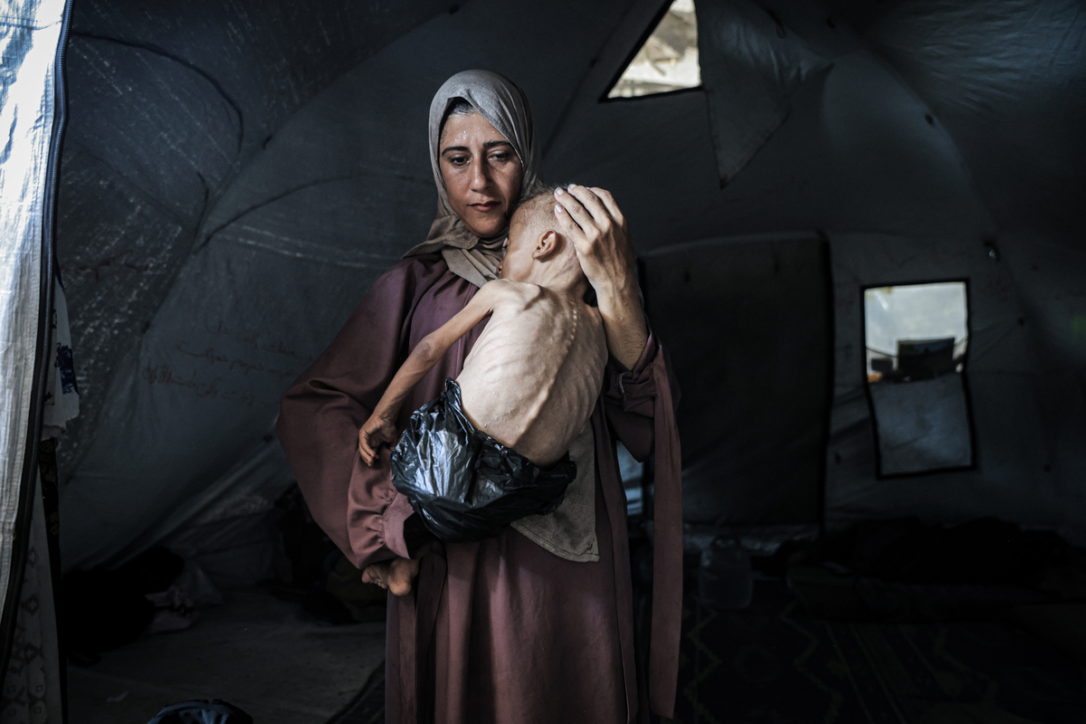Muhammad Zakariya Ayyoub al-Matouq, a 1.5-year-old child in Gaza City, Gaza, faces life-threatening malnutrition as the humanitarian situation worsens due to ongoing Israeli attacks and blockade, on July 21, 2025. [Ahmed Jihad Ibrahim Al-arini - Anadolu Agency]