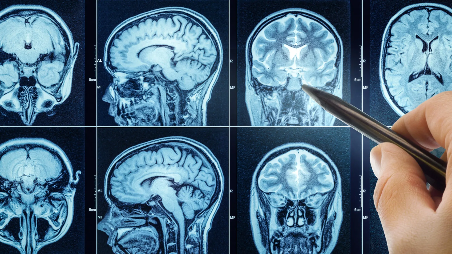 Feeling mental exhaustion? These two areas of the brain may control whether people give up or persevere