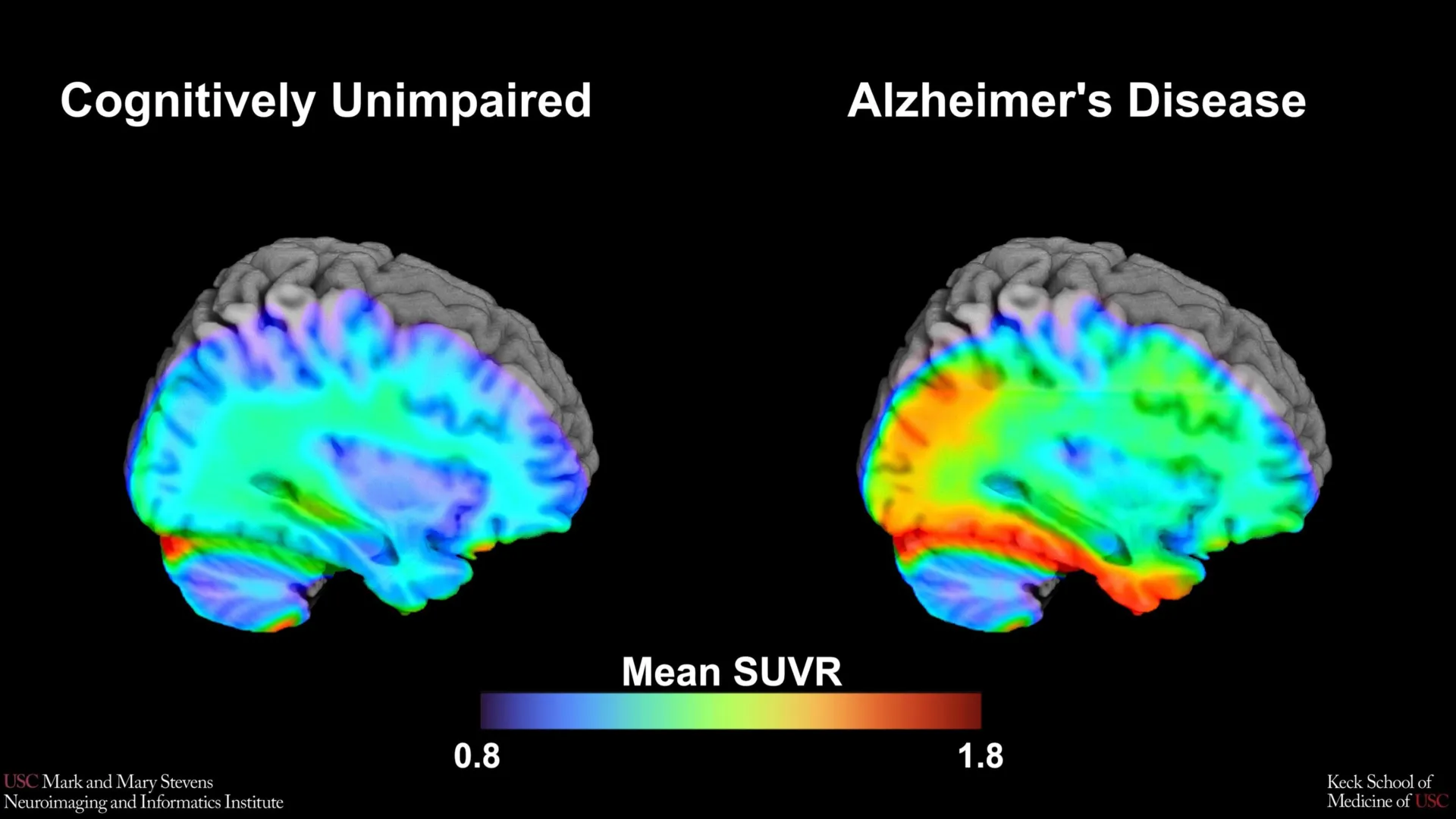 This brain scan sees Alzheimer’s coming—but only in some brains