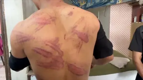 BBC An Afghan citizen shows bruises on his back.