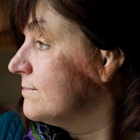 The Boston Globe/Getty Images Gina Russo, a survivor of the 2003 fire at The Station nightclub, shows burn scars on the side of her face.