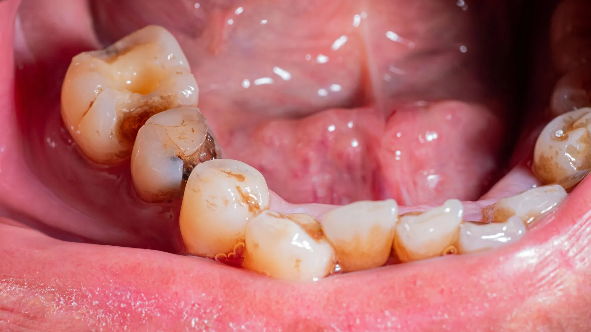 Fixing a tooth infection may improve blood sugar and heart health