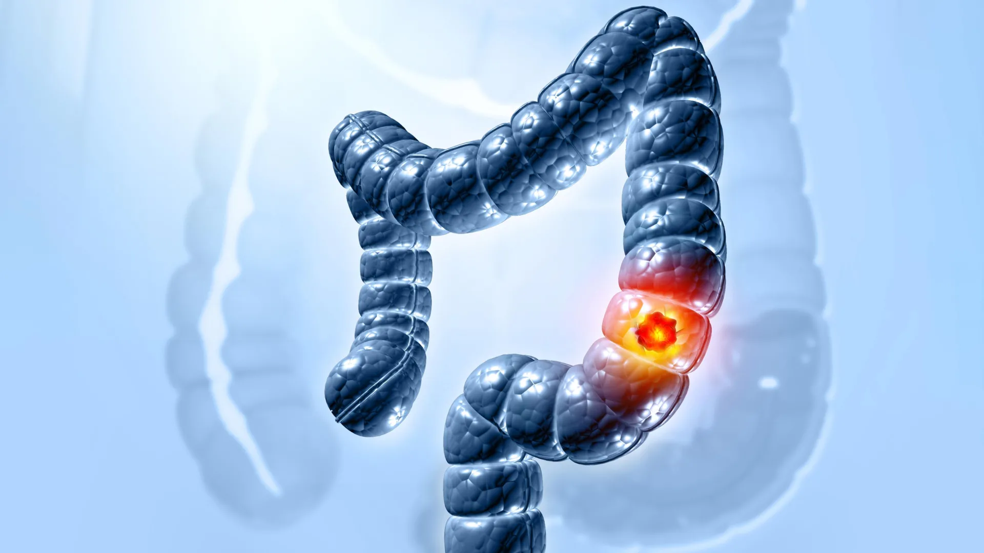 Hidden virus in your gut may be linked to colon cancer