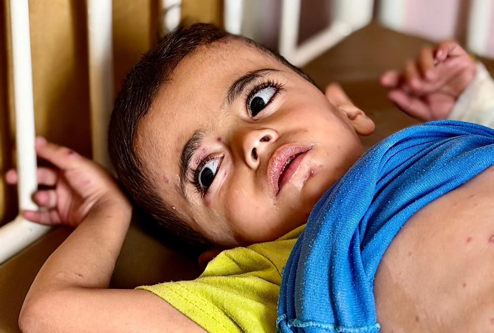 Burn-like rashes and hunger: Gaza’s children face skin disease crisis | Israel-Palestine conflict News