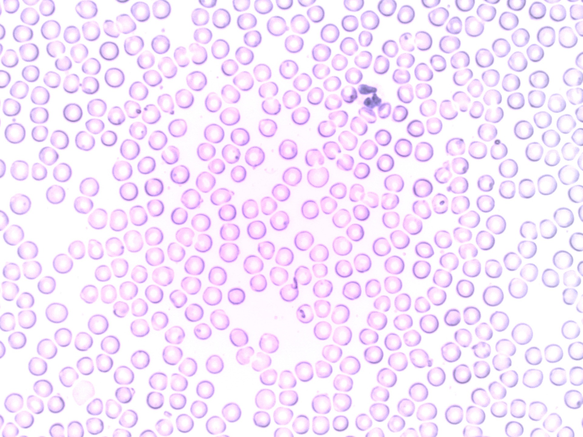 Protein Inhibition Found to Sensitize Aggressive Lymphoma to Therapy