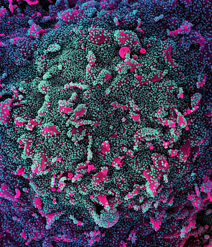 Are Autoantibodies to Blame for Long COVID?