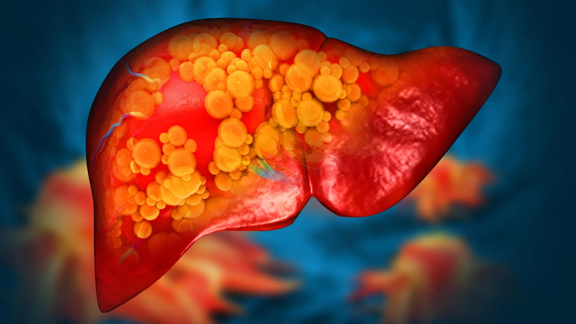 New drug could finally stop deadly fatty liver disease