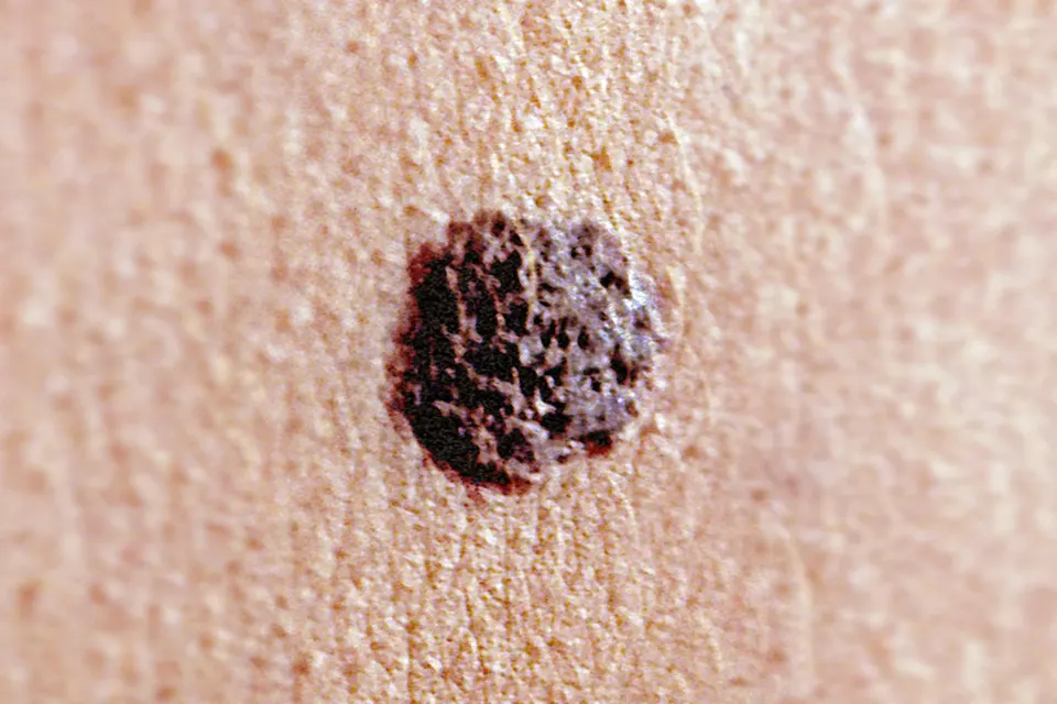 New Study Shows How mRNA Vaccines Could Transform Cancer Treatment