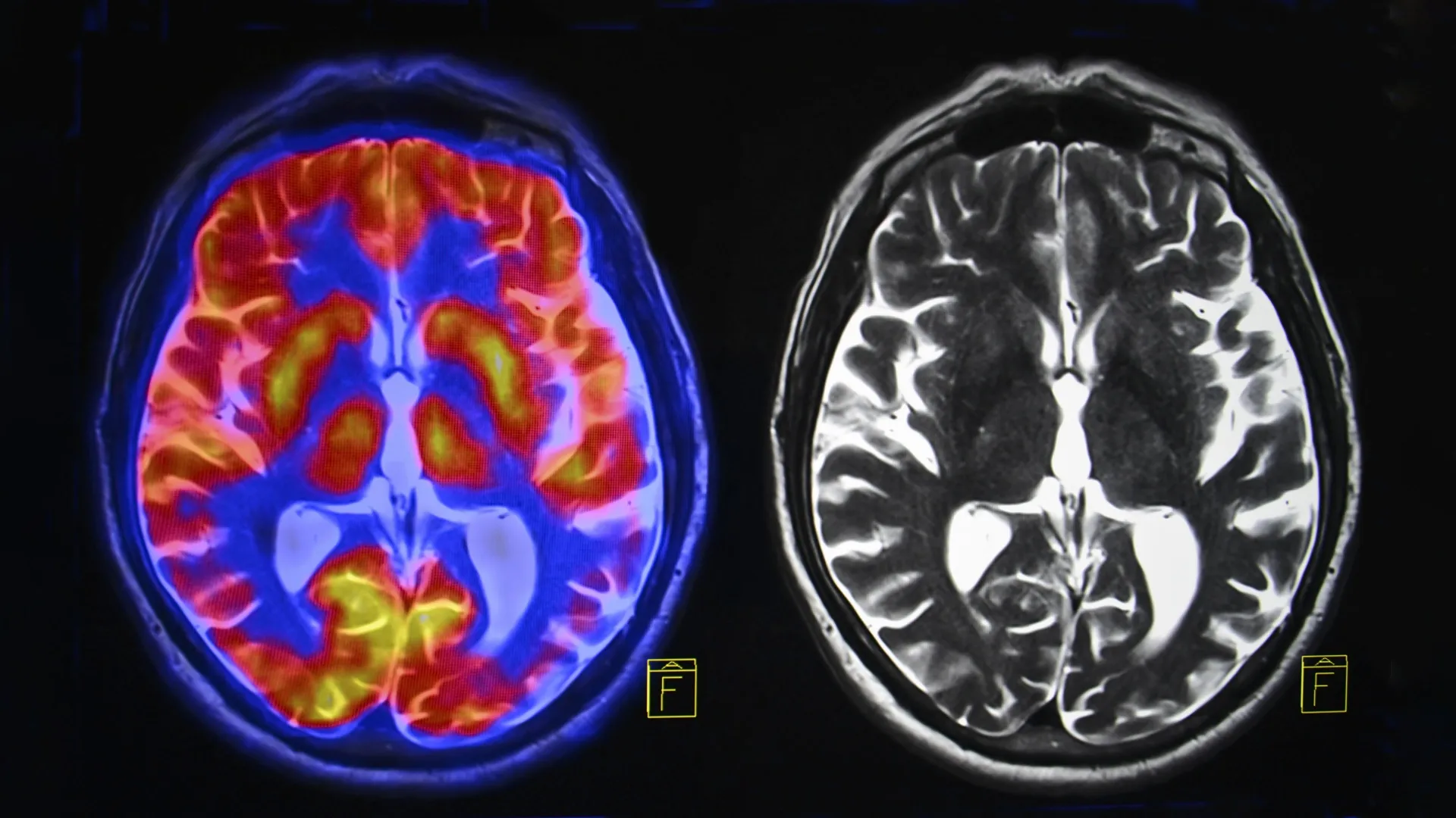 Brain scans reveal two distinct types of autism