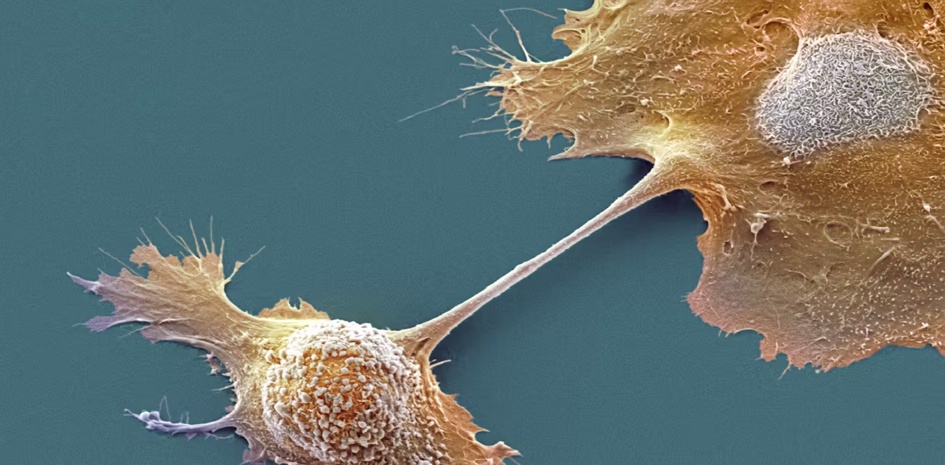 Breakthrough drug nearly doubles survival with advanced pancreatic cancer – an oncologist explains how daraxonrasib overcame an ‘undruggable’ disease